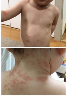 1歳7ヶ月首回り身体アトピー.jpg