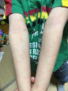 4歳3月18日肘と腕.jpg