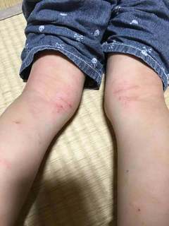 4歳3月18日膝裏.jpg