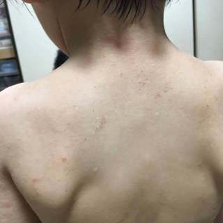 4歳4月首筋背中.jpg