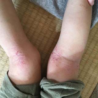 4歳5月初旬膝裏.jpg
