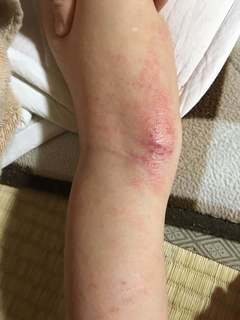 4歳5月末膝裏掻きむしり.jpg