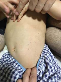 4歳夏水いぼお腹.jpg