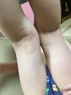 4歳誕生日膝裏.jpg