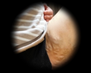 妊婦静脈瘤鼠径部.jpg