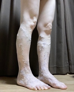 寝起きでも静脈瘤.jpg