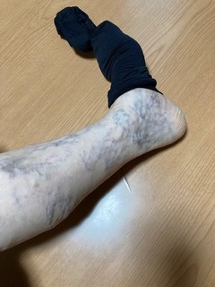 着圧ソックスで静脈瘤抑える.jpg